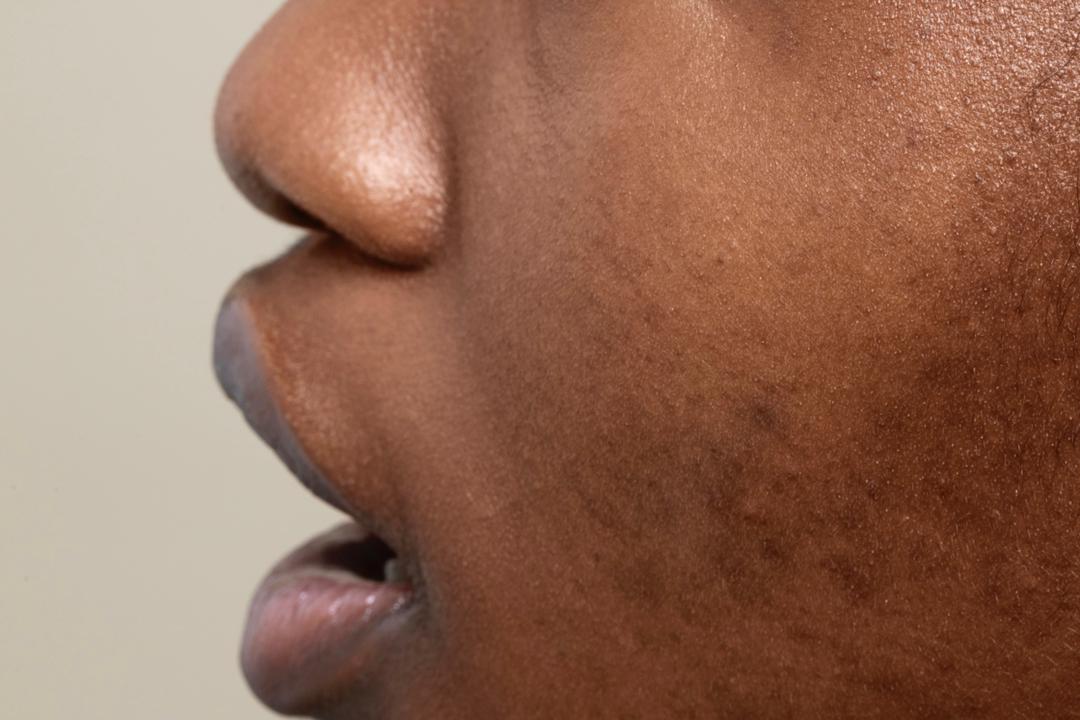 The Best Ingredients for Reducing Hyperpigmentation in Your Skin
